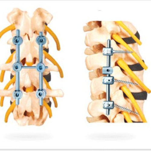 Spinal stabilization cum fixation system