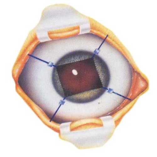 Iris retractor