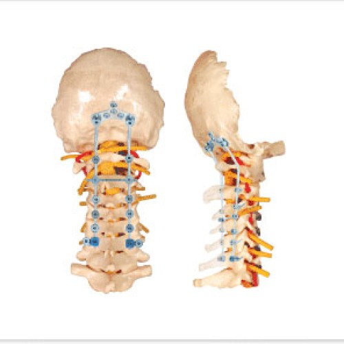 Thoracic spinal fixation system