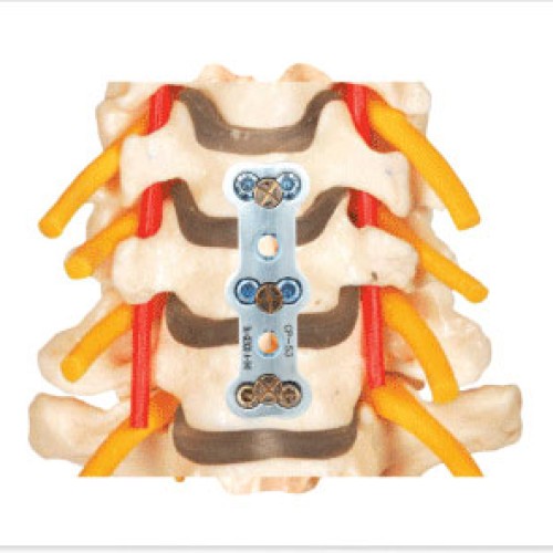 Cervical anterior plating system