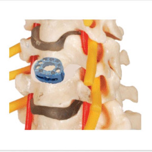 Cervical anterior fusion cage