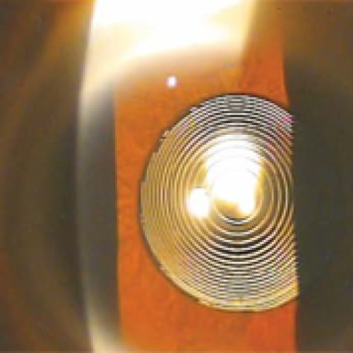 Multifocal lens