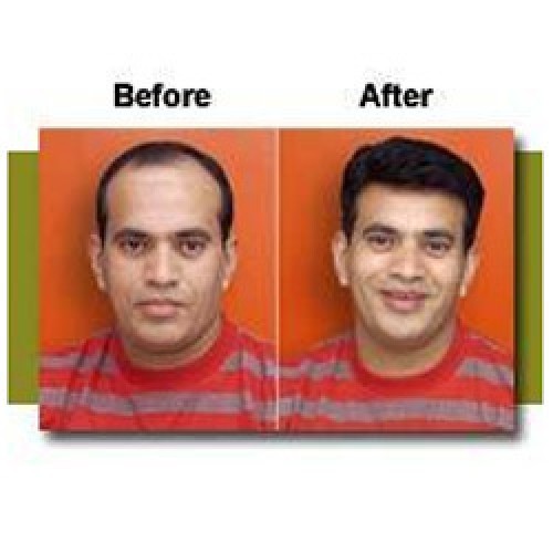 Hair replacement systems