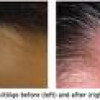 Vitiligo Laser Treatment
