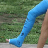 Fiberglass Splint